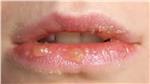 What Causes Lip Rash? (Treatment and Symptoms)