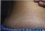 How to Get Rid of Stretch Marks Fast