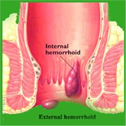 Venapro Homeopathic Hemorrhoid Relief