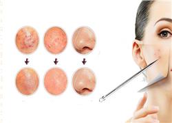 How to get rid of blackheads easily